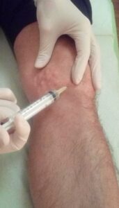 Ο Ιατρός Φυσικής Ιατρικής και Αποκατάστασης Γκατζούνης Θεόδωρος εφαρμόζει τη μέθοδο της θεραπευτικής μεσοθεραπείας σε ασθενή με πάθηση του γόνατος